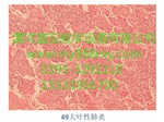 病理切片-图为大叶性肺炎